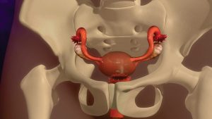 hysterectomy
