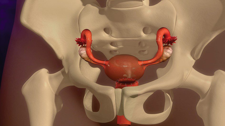 hysterectomy